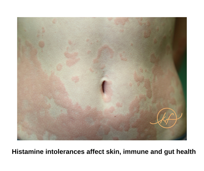 Understanding Histamine: Impact on your immune system, skin, gut health and why it flares up more during perimenopause