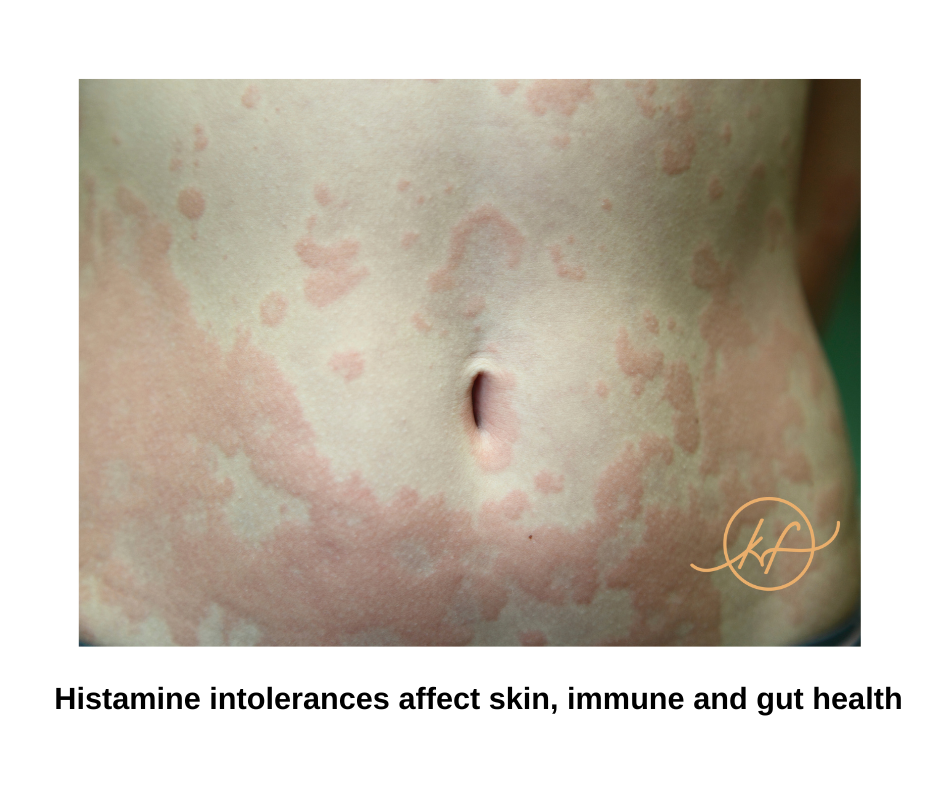 glutathione glutamine Histamine Intolerance and Gluten